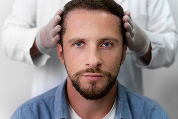 Injerto capilar Turquía - Médico capilar realizando el diseño de la línea frontal del cabello a un hombre para un tratamiento de implante capilar Turquía