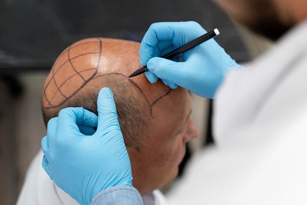 Mejor cirujano capilar España - Tricólogo reconocido como uno de los mejores doctores injerto capilar España realizando el boceto del injerto capilar Madrid a un hombre con alopecia en la coronilla