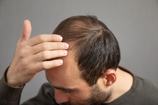 Alopecia - Hombre con calvicie en las entradas y coronilla tocándose la cabeza antes de un implante capilar Madrid