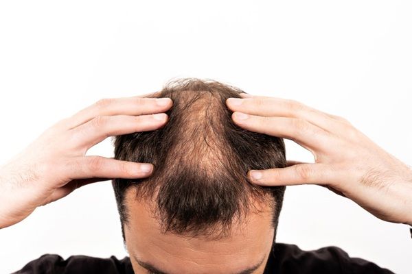 Alopecia - Hombre con calvicie androgénica tacándose el cabello antes de un trasplante capilar Madrid