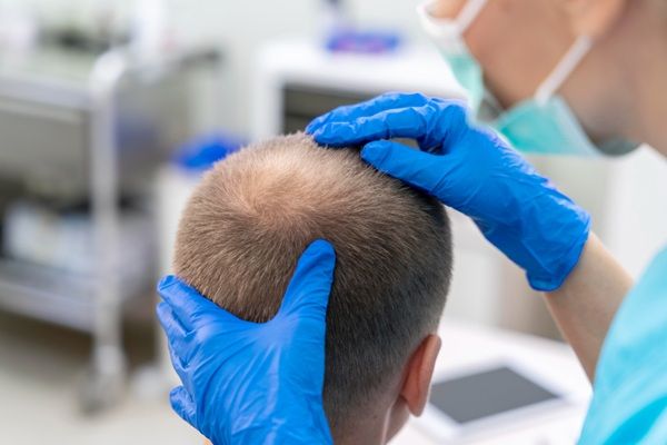 Alopecia - Tricólogo de una de las mejores clínicas injerto capilar Madrid evaluando a un hombre con calvicie avanzada para realizar un implante capilar Madrid