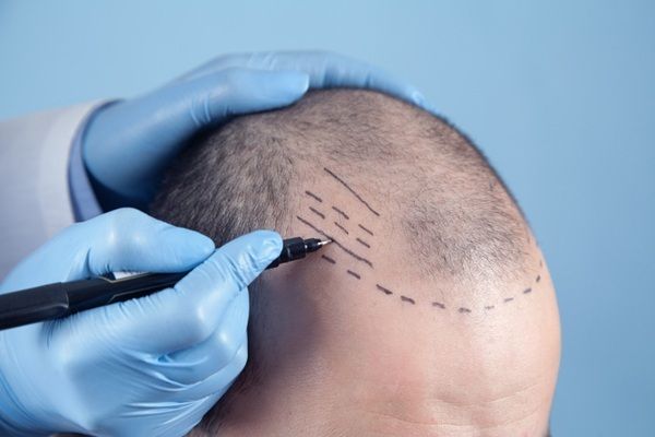 Precio trasplante capilar Turquía - Tricólogo realizando el boceto del injerto capilar Turquía a un hombre con alopecia avanzada para recuperar el cabello de manera natural