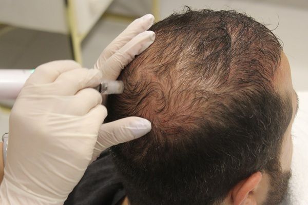 Precio trasplante capilar Turquía - Médico capilar evaluando el cuero cabelludo de un hombre con alopecia para determinar el precio injerto capilar Turquía