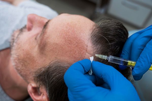 Injerto capilar FUE - Médico tricólogo realizando un injerto capilar Madrid con la técnica FUE a un hombre con pérdida de cabello en las entradas
