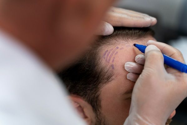 Injerto capilar FUE - Tricólogo realizando el boceto del injerto capilar Madrid a un hombre con alopecia androgénica