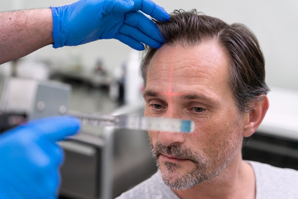 Tricólogo realizando mediciones de la línea frontal del pelo de un hombre con pérdida de cabello en las entradas