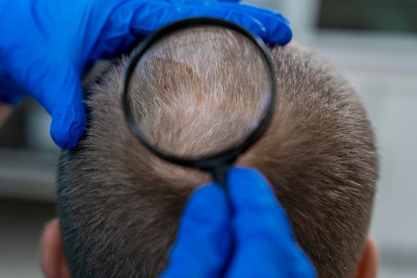 Unidades foliculares - Médico tricólogo de la mejor clínica injerto capilar Madrid evaluando el cuero cabelludo de un hombre con alopecia