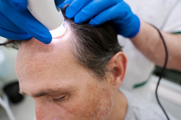 Tricólogo evaluando el cuero cabelludo de un hombre con alopecia para determinar si es apto para un injerto capilar Madrid