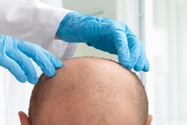 Injerto capilar España- paciente siendo examinado para injerto de cabello