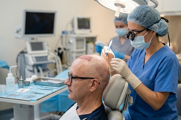 Injerto capilar con alopecia areata - Médico tricólogo realizando un trasplante capilar a un hombre con alopecia areata