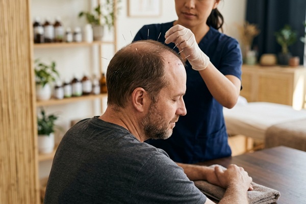 Acupuntura para la caída del cabello - Esteticista realizando un tratamiento de acupuntura a un hombre con pérdida capilar para frenar la alopecia