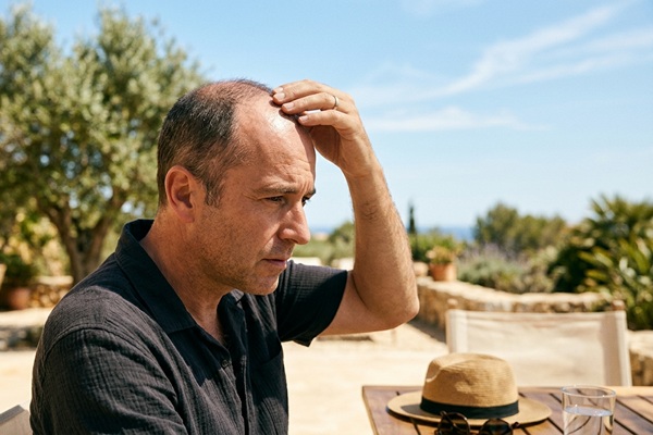 Hombre con pérdida de cabello debido a la radiación UV que deteriora la queratina capilar