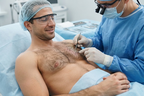 Trasplante de pelo corporal - Médico tricólogo realizando un Body Hair Transplant de folículos del pecho a un hombre con alopecia